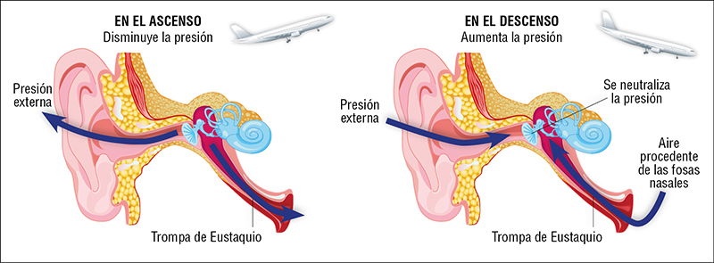 Barotraumatismo durante vuelos, a la izquierda el efecto que se produce en el ascenso del avión y a la derecha en el descenso.