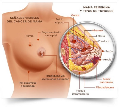 Mapa de imagen en el que aparecen señaladas las distintas partes de las mamas.